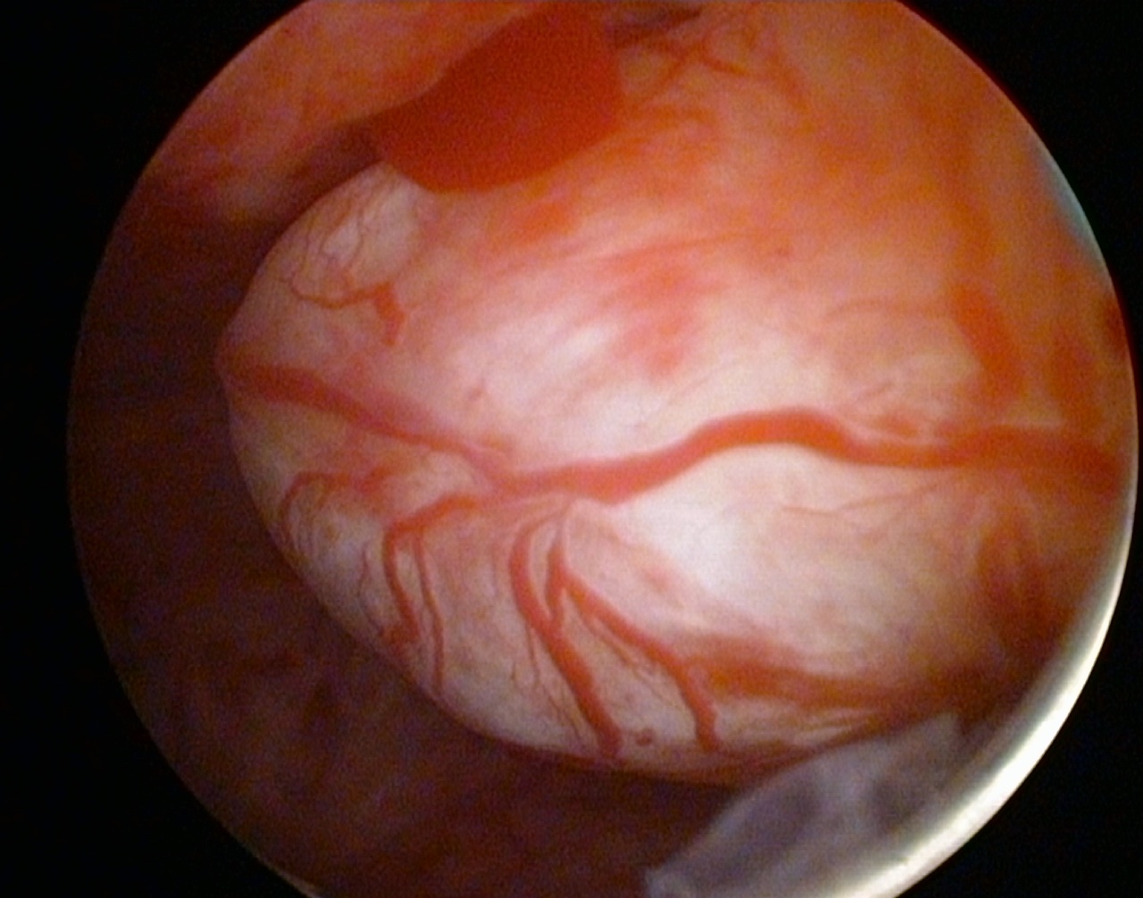 EN hystéroscopie on visualise un fibrome 