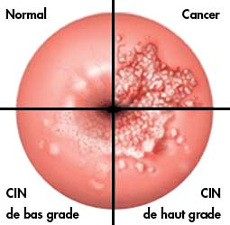 Cabinet gynécologie Ste Maxime - Prévention cancer du col