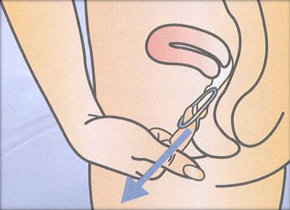 Cabinet gynécologie Ste Maxime - Contraception et anneau vaginal