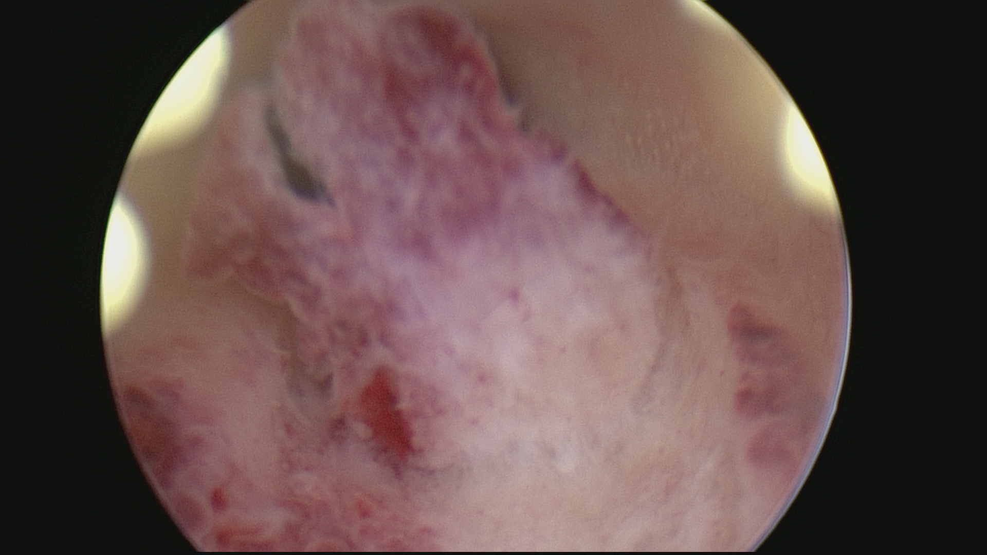 Ici on peut voir un petit polype de la face postérieure de la cavité utérine